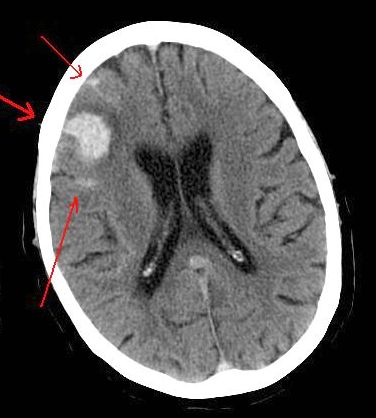 CT brain scan showing hematoma in left frontal lobe